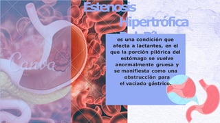 Estenosis hipertrofica del piloro en cirugía pediatrica y su manejo | PPTX