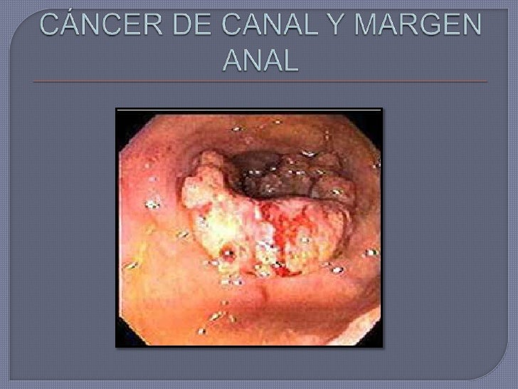 Carcinoma anal canal