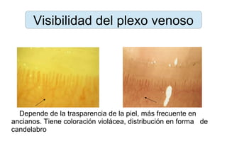 Visibilidad del plexo venoso
Depende de la trasparencia de la piel, más frecuente en
ancianos. Tiene coloración violácea, distribución en forma de
candelabro
 