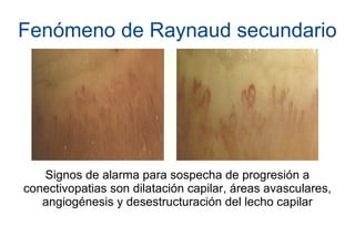 Fenómeno de Raynaud secundario
Signos de alarma para sospecha de progresión a
conectivopatias son dilatación capilar, áreas avasculares,
angiogénesis y desestructuración del lecho capilar
 