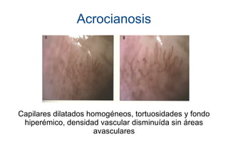 Acrocianosis
Capilares dilatados homogéneos, tortuosidades y fondo
hiperémico, densidad vascular disminuída sin áreas
avasculares
 