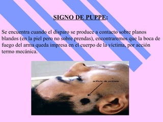 SIGNO DE PUPPE :  Se encuentra cuando el disparo se produce a contacto sobre planos blandos (en la piel pero no sobre prendas), encontraremos que la boca de fuego del arma queda impresa en el cuerpo de la víctima, por acción termo mecánica. 