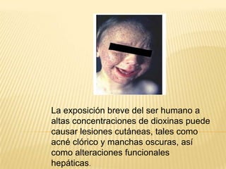 La exposición breve del ser humano a
altas concentraciones de dioxinas puede
causar lesiones cutáneas, tales como
acné clórico y manchas oscuras, así
como alteraciones funcionales
hepáticas.
 