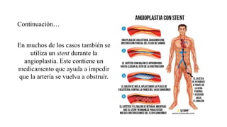 Continuación…
En muchos de los casos también se
utiliza un stent durante la
angioplastia. Este contiene un
medicamento que ayuda a impedir
que la arteria se vuelva a obstruir.
 
