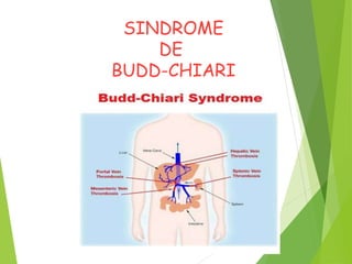 SINDROME
DE
BUDD-CHIARI
 
