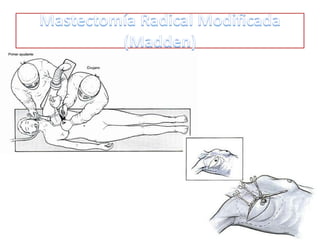 •
Incisión horizontal de Steward. Modificada en función de:
• Localización del tumor.
• Del volumen y forma de la mama.
• Posibilidad de reconstrucción en un 2º tiempo.
1.Colgajo cutáneo superior hasta el borde inferior de la clavícula.
2.Colgajo cutáneo inferior: sobrepasar algo el surco submamario y llegar
3.hasta la inserción de los oblicuos y recto anterior del abdomen.
4.Disección de la glándula mamaria y fascia del pectoral.
5.Preserva ambos músculos pectorales.

 