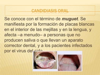 CANDIDIASIS ORAL
Se conoce con el término de muguet. Se
manifiesta por la formación de placas blancas
en el interior de las mejillas y en la lengua, y
afecta –a menudo– a personas que no
producen saliva o que llevan un aparato
corrector dental, y a los pacientes infectados
por el virus del sida.
 
