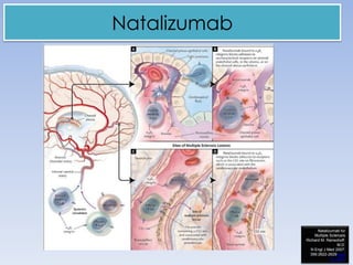 Natalizumab

Natalizumab for
Multiple Sclerosis
Richard M. Ransohoff,
M.D.
N Engl J Med 2007;
356:2622-2629June
21, 2007

 