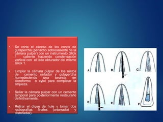 • Se corta el exceso de los conos de
gutapercha (penacho sobresaliente de la
cámara pulpar) con un instrumento Glick
1 caliente haciendo condensación
vertical con el lado obturador del mismo
Glick 1.
• Limpiar la cámara pulpar de los restos
de cemento sellador y gutapercha
humedeciendo una torunda en
cloroformo o xylol para completar la
limpieza.
• Sellar la cámara pulpar con un cemento
temporal para posteriormente restaurarlo
definitivamente.
• Retirar el dique de hule y tomar dos
radiografías finales (ortorradial y
distoradial).
 