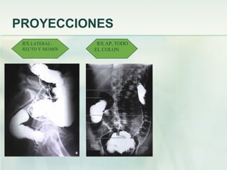 PROYECCIONES
RX LATERAL:
RECTO Y SIGMOI
RX AP, TODO
EL COLON
 
