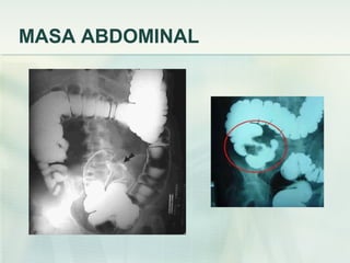 MASA ABDOMINAL
 