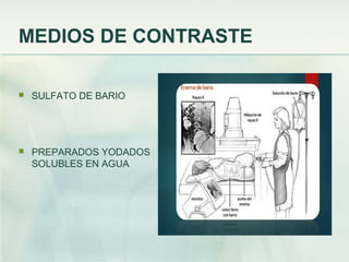 MEDIOS DE CONTRASTE
 SULFATO DE BARIO
 PREPARADOS YODADOS
SOLUBLES EN AGUA
 