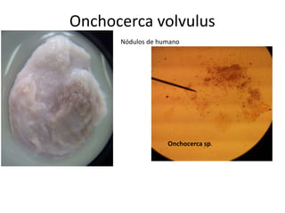 Onchocerca volvulus
Nódulos de humano

Onchocerca sp.

 