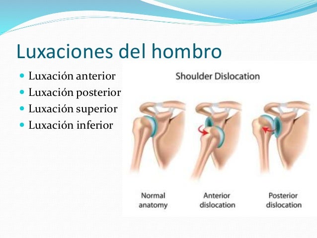 Las complicaciones neurológicas a la osteocondrosis de la columna vertebral