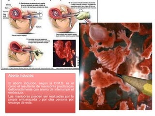 Aborto Inducido:

El aborto inducido, según la O.M.S. es el
como el resultante de maniobras practicadas
deliberadamente con ánimo de interrumpir el
embarazo.
Las maniobras pueden ser realizadas por la
propia embarazada o por otra persona por
encargo de esta.
 