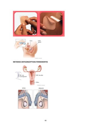 METODOS ANTICONCEPTIVOS PERMANENTES
40
 