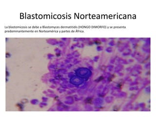 Blastomicosis Norteamericana
La blastomicosis se debe a Blastomyces dermatitidis (HONGO DIMORFO) y se presenta
predominantemente en Norteamérica y partes de África.
 