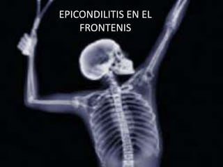 EPICONDILITIS EN EL
FRONTENIS

 