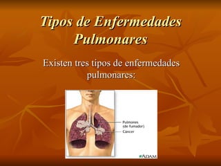 Tipos de Enfermedades Pulmonares Existen tres tipos de enfermedades pulmonares: 