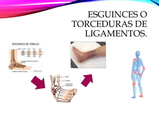 ESGUINCES O
TORCEDURAS DE
LIGAMENTOS.
 