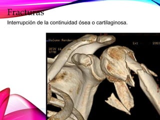 Fracturas
Interrupción de la continuidad ósea o cartilaginosa.
 