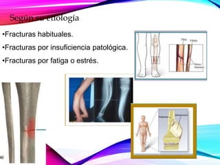 Según su etiología
•Fracturas habituales.
•Fracturas por insuficiencia patológica.
•Fracturas por fatiga o estrés.
 