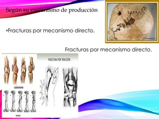 Según su mecanismo de producción
•Fracturas por mecanismo directo.
Fracturas por mecanismo directo.
 