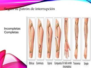 Según su patrón de interrupción
Incompletas
Completas
 