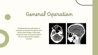General Operation
Computerized reconstruction: A
computer processes the data to form
sliced ​
​
(axial) images of the body.
These can then be reconstructed in
3D or in other planes (sagittal,
coronal).
 