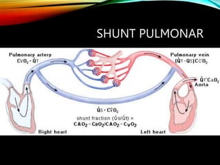 SHUNT PULMONAR
 