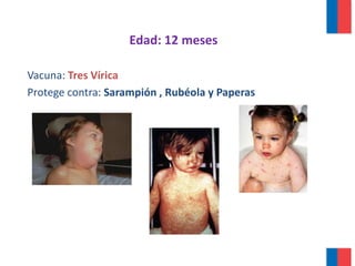 Edad: 12 meses
Vacuna: Tres Vírica
Protege contra: Sarampión , Rubéola y Paperas
 