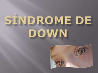 Síndrome de down 
