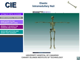 CIE                                    Elastic
                                      Intramedullary Nail


AUTOMATIC DISTAL BLOCKING

EASIER SURGICAL TECHNIQUE

ADAPTATION TO THE
INTRAMEDULLARY CANAL

MINIMALLY INVASIVE FOR
SURGEON AND PATIENT

QUICK IMPLANTATION AND
SHORT POST-SURGERY




                               UNIVERSITY HOSPITAL OF CANARIAS
                            CANARY ISLANDS INSTITUTE OF TECHNOLOGY
 