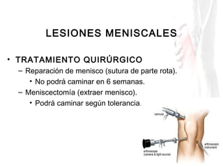 LESIONES MENISCALES
• TRATAMIENTO QUIRÚRGICO
– Reparación de menisco (sutura de parte rota).
• No podrá caminar en 6 seman...