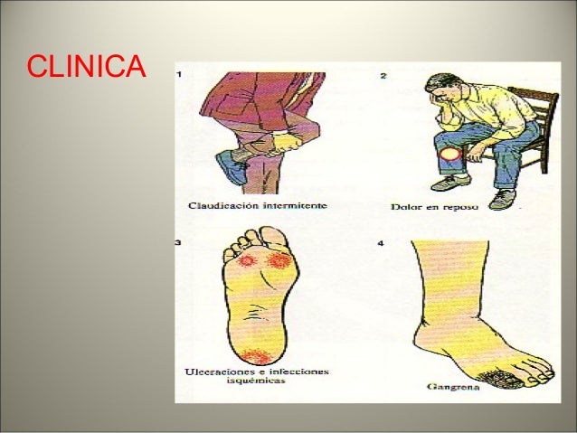 Arteriopatia periferica