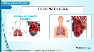 FISIOPATOLOGIA
EDEMA AGUDO DE PULMON
MI. Eliannys lopez
Fuente: http://es.slideshare.net/FLATYY19/edema-agudo-de-pulmn-15227033
 