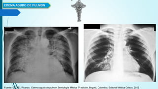 EDEMA AGUDO DE PULMON
Fuente: CEDIEL Ricardo; Edema agudo de pulmon Semiología Médica 7ª edición, Bogotá, Colombia, Editorial Médica Celsus, 2012
 