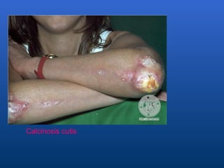 Calcinosis cutis   