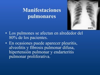 Manifestaciones  pulmonares   Los pulmones se afectan en alrededor del 80% de los pacientes. En ocasiones puede aparecer pleuritis, alveolitis y fibrosis pulmonar difusa, hipertensión pulmonar y endarteritis pulmonar proliferativa.  