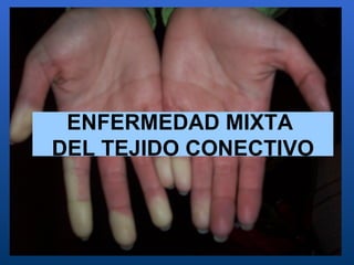 ENFERMEDAD MIXTA  DEL TEJIDO CONECTIVO 