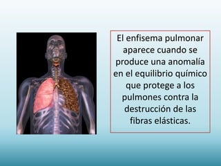 ¿Cómo se diagnostica el enfisema
pulmonar?
• Exámenes de funcionamiento pulmonar.
Exámenes de diagnóstico que ayudan a med...