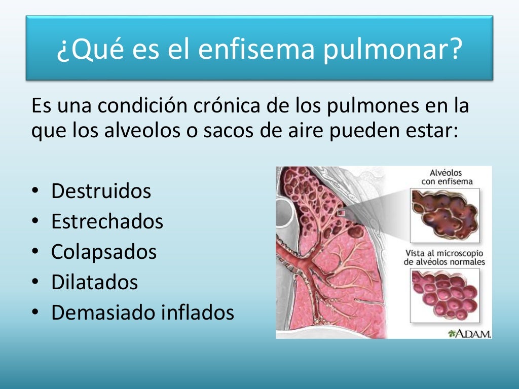 enfisema pulmonar