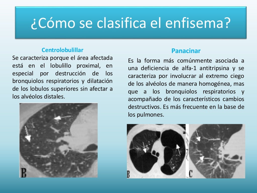 enfisema pulmonar