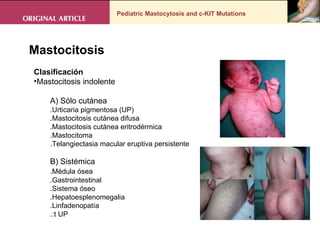Pediatric Mastocytosis and c-KIT Mutations Mastocitosis  Clasificación Mastocitosis indolente A) Sólo cutánea .Urticaria pigmentosa (UP) .Mastocitosis cutánea difusa .Mastocitosis cutánea eritrodérmica .Mastocitoma .Telangiectasia macular eruptiva persistente B) Sistémica .Médula ósea .Gastrointestinal .Sistema óseo .Hepatoesplenomegalia .Linfadenopatía .:t UP 