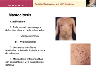 Pediatric Mastocytosis and c-KIT Mutations Mastocitosis  Clasificación 2) Enfermedad hematológica: determina el curso de la enfermedad. Mieloproliferativa B)  Mielodisplásica 3) Leucemias de células mastoides: sobrevida limitada a pesar de la terapia. 4) Mastocitosis linfadenopática con eosinofilia (:!: UP) (Mastocitosis agresiva) 
