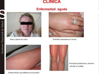 Rash y edema en rostro Poliartritis edematosa en manos
Eritema difuso que palidece con la presión
Hinchazón periarticular y derrame
articular en rodillas
CLINICA
Enfermedad aguda
 