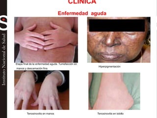 Etapa final de la enfermedad aguda. Tumefacción en
manos y descamación fina
Hiperpigmentación
Tenosinovitis en manos Tenosinovitis en tobillo
CLINICA
Enfermedad aguda
 