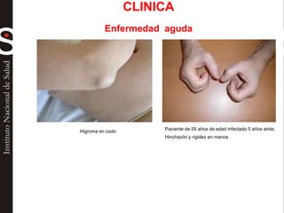 Higroma en codo Paciente de 55 años de edad infectado 5 años atrás.
Hinchazón y rigidez en manos
CLINICA
Enfermedad aguda
 