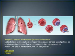 Imagen 4 Lesiones Pulmonares típicas en tuberculosis
La bacteria de la tuberculosis entra por vía aérea, es por eso que el pulmón es
el primer destino de esta, formando lesiones típicas con necrosis de
licuefacción, por la presencia de este microorganismo.
Referencia
Imagen 4
 