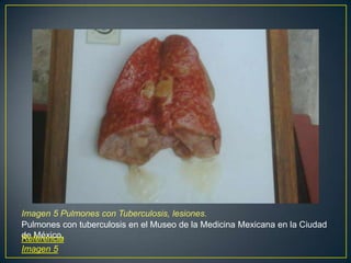 Imagen 5 Pulmones con Tuberculosis, lesiones.
Pulmones con tuberculosis en el Museo de la Medicina Mexicana en la Ciudad
de México.Referencia
Imagen 5
 
